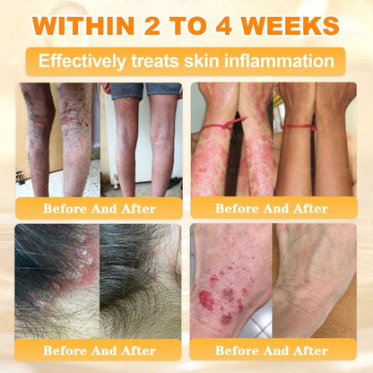 🔥 LAST DAY 80% OFF🔥 Aeehfeng® Bee Venom Skin Restoration Cream 🔥🔥