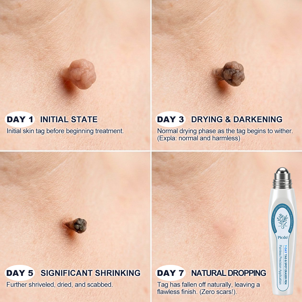 😁 7-𝐷𝑎𝑦 𝗧𝐚𝐠 & 𝗦𝗽𝐨𝐭 𝐄𝐫𝒂𝒔𝒆𝒓(Zero Pain, Zero 𝐒𝐜𝐚𝒓𝒔 Rollerball)💪