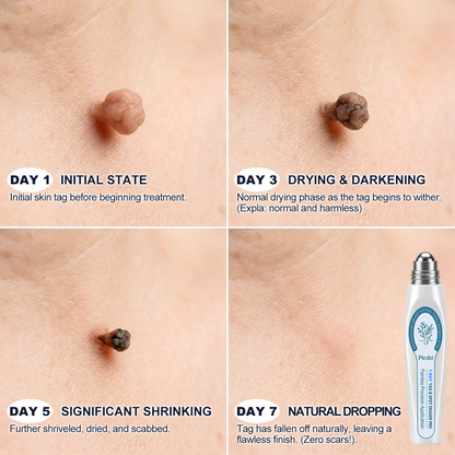 😁 7-𝐷𝑎𝑦 𝗧𝐚𝐠 & 𝗦𝗽𝐨𝐭 𝐄𝐫𝒂𝒔𝒆𝒓(Zero Pain, Zero 𝐒𝐜𝐚𝒓𝒔 Rollerball)💪